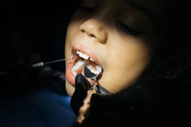 Hipoplazja szkliwa zębów