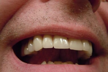 Górne zęby zachodzą na dolne